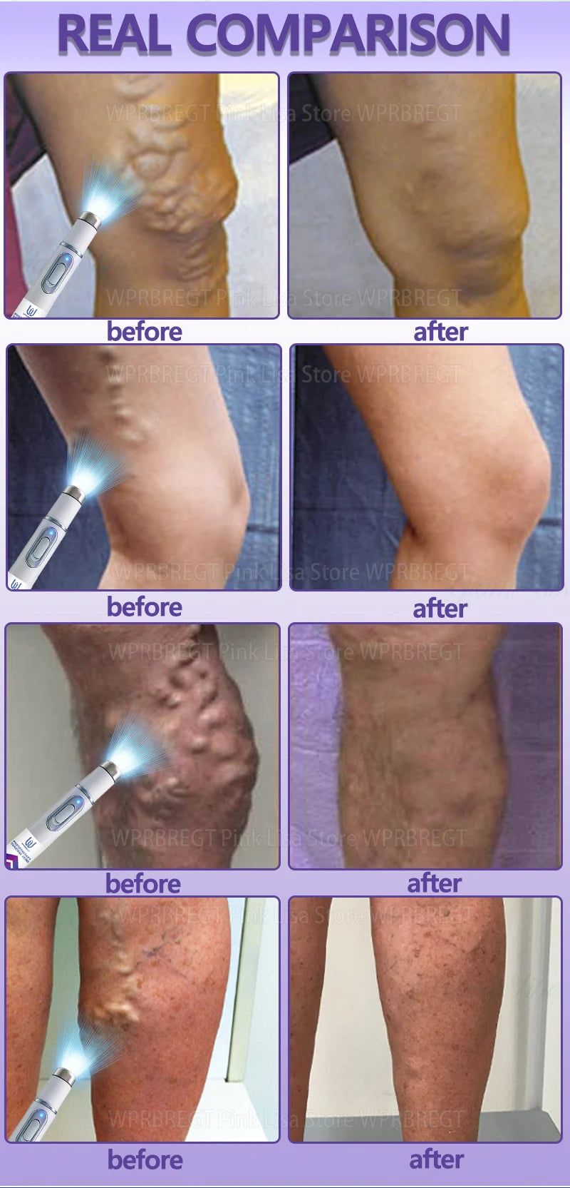 Red light therapy device supporting cosmetic skin appearance and leg comfort, external use only