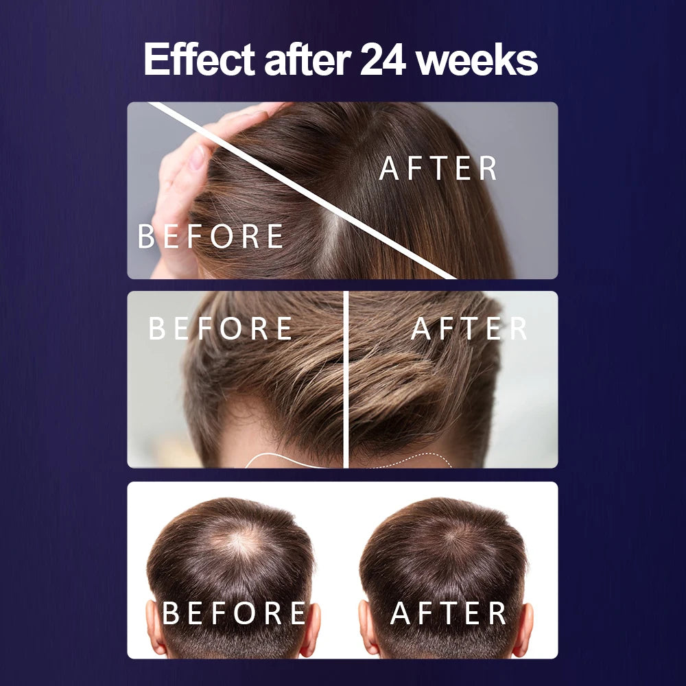 LLLT hair therapy cap with 266 lasers for thinning hair treatment