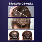 LLLT hair therapy cap with 266 lasers for thinning hair treatment