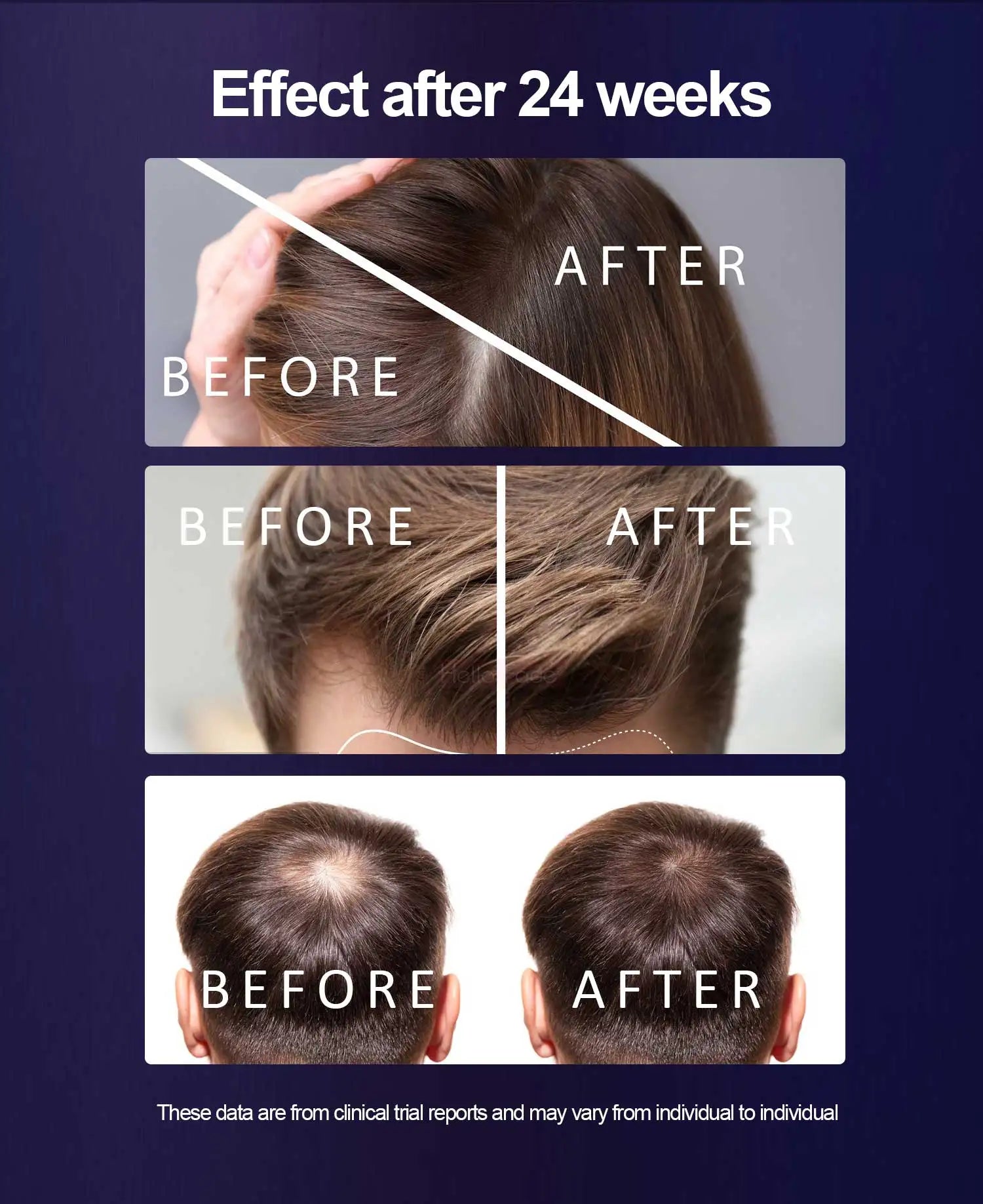 lightweight wearable laser cap for hair thinning and scalp support